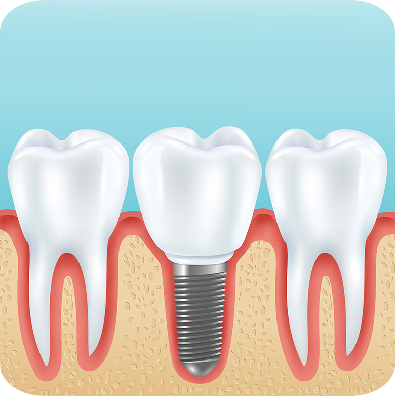Affordable Teeth Implants