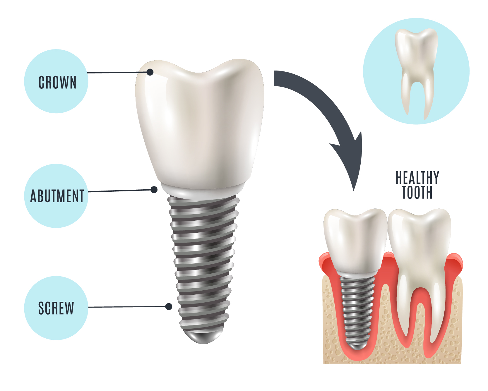 Affordable Teeth Implants Near Me