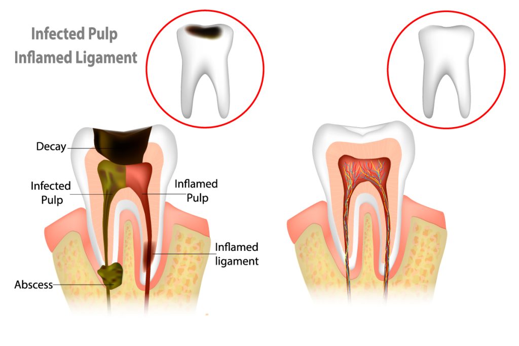 Affordable Root Canal Therapy