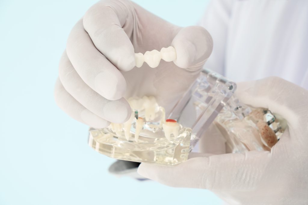 Affordable Dental Bridges