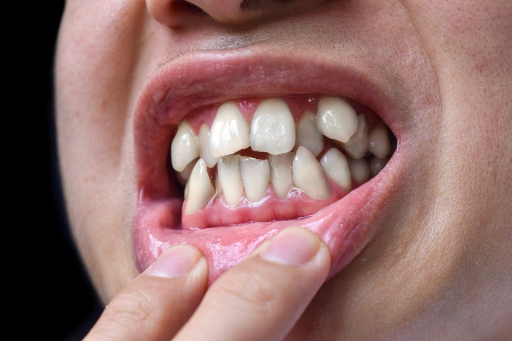 Best Cosmetic Dental Implants