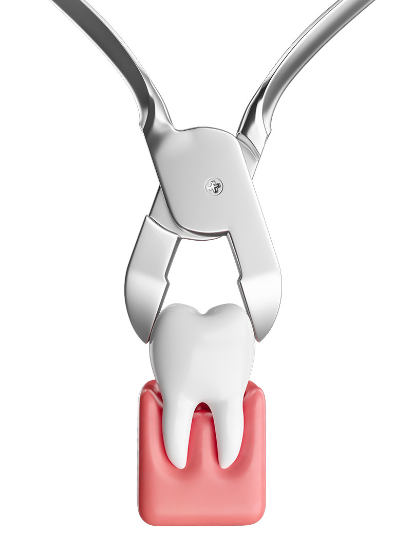 What-Are-Dental-Extractions-garland