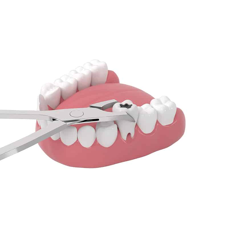 Dental Extractions