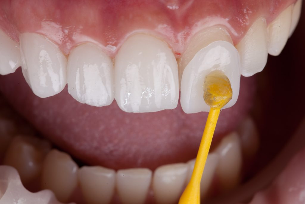 Best Dentist For Veneers