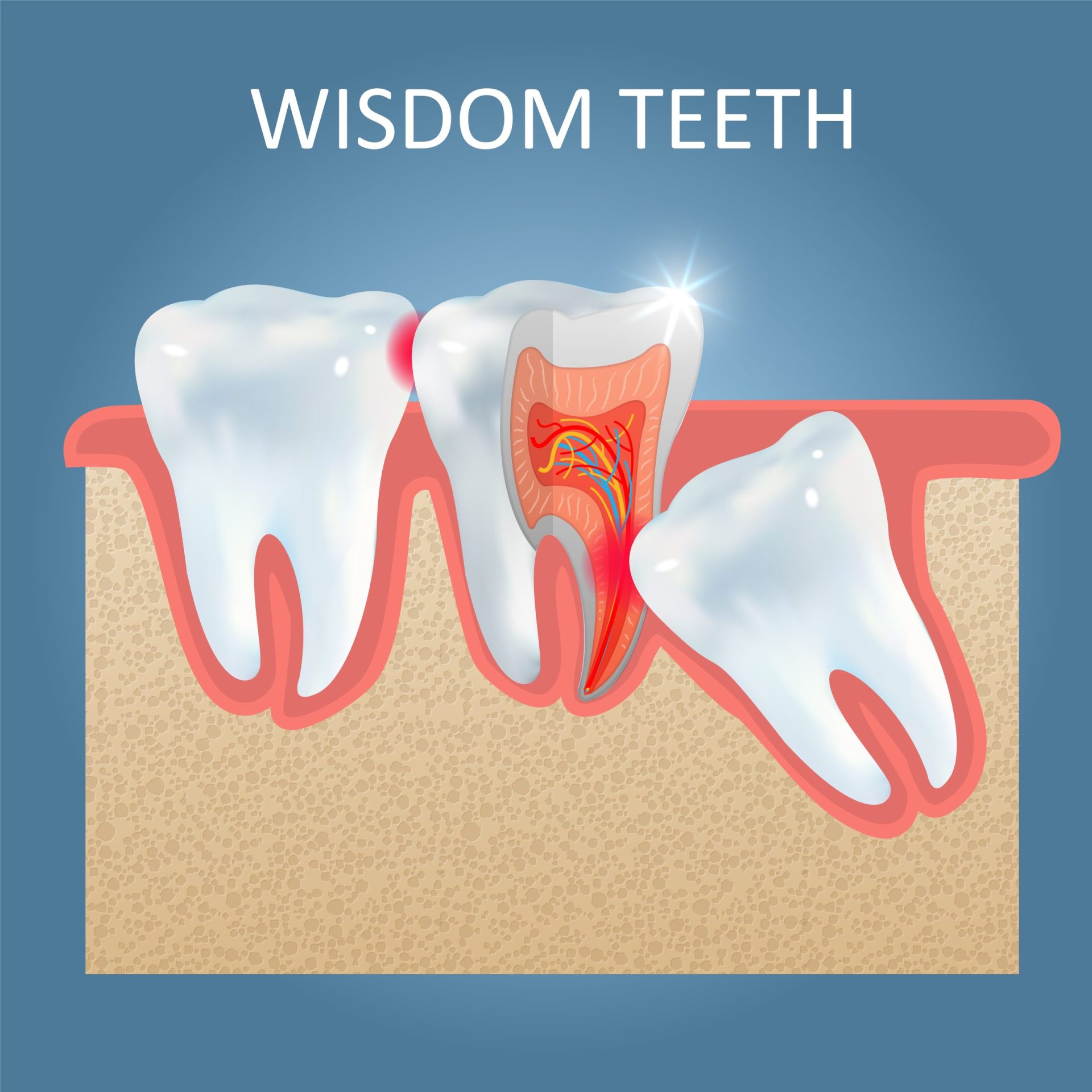 Wisdom Tooth Extractions