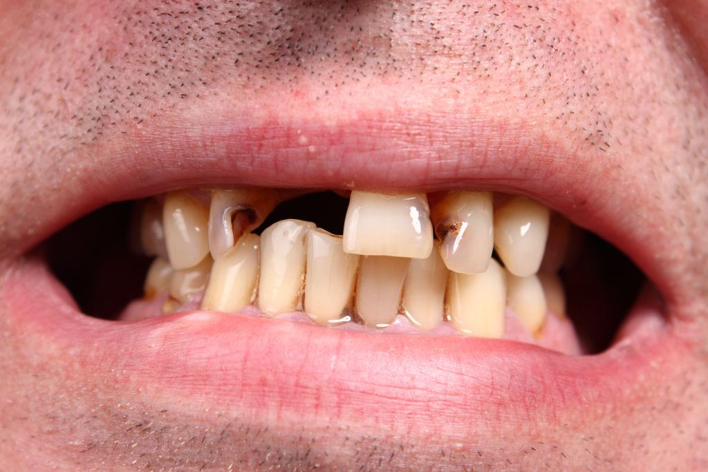 Cosmetic Dental Implants