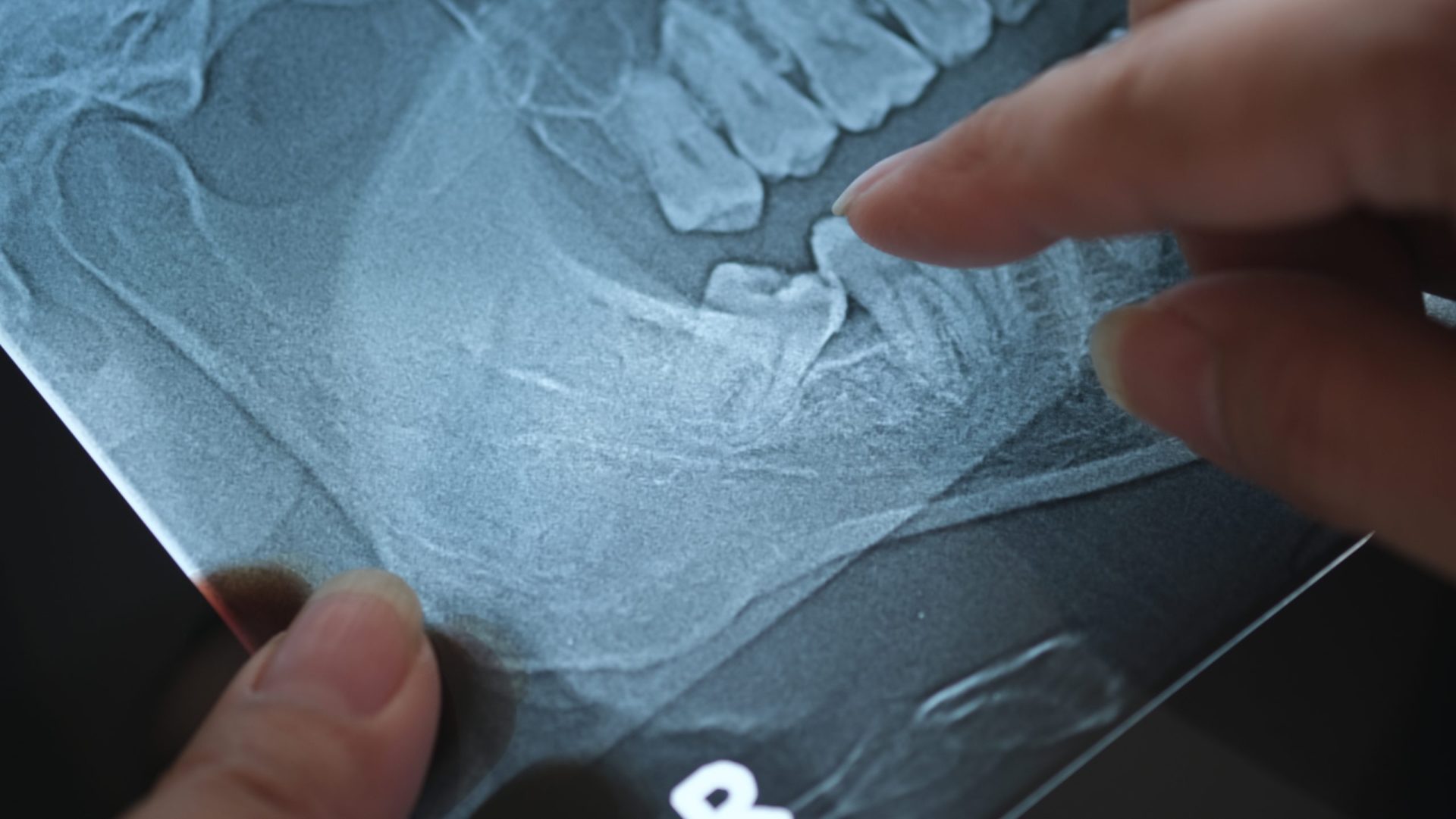 Complete Guide to Wisdom Tooth Extractions