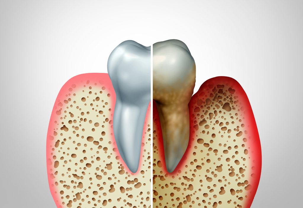Affordable Teeth Cleaning