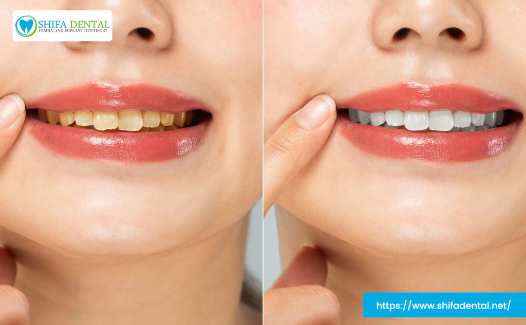 tooth-discoloration