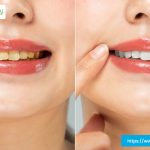 tooth-discoloration