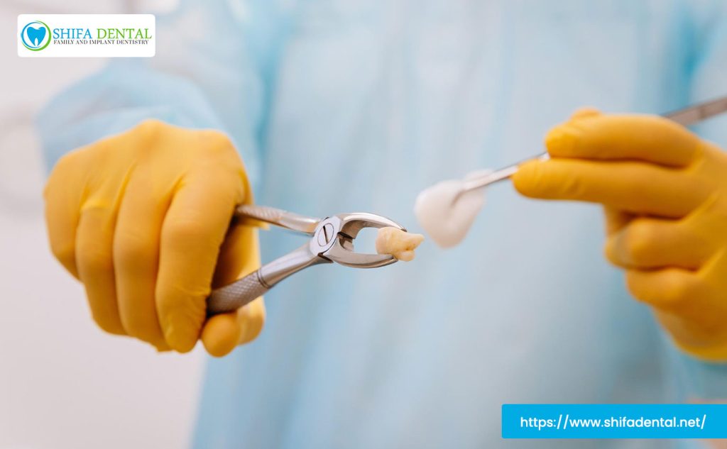 tooth extraction treatment
