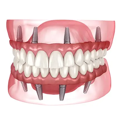 All-on-4 Dental Implants