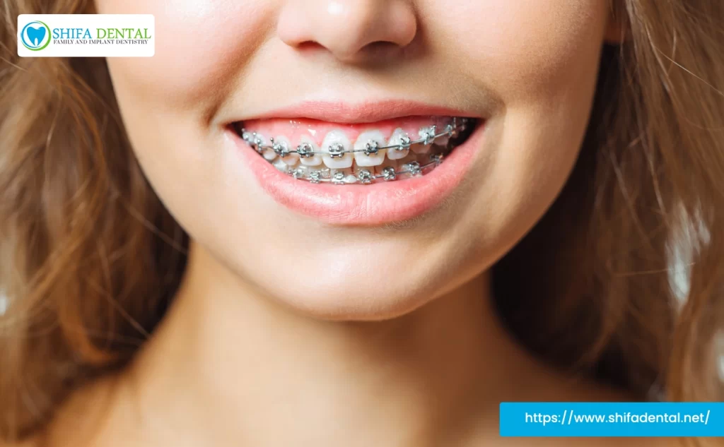 Braces for Crossbite Garland