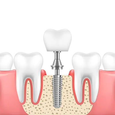 Dental Implants
