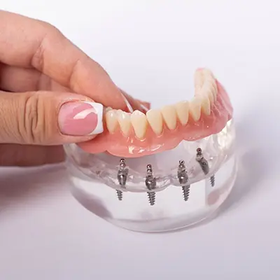 Implant Over Dentures
