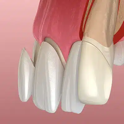 Porcelain Veneers