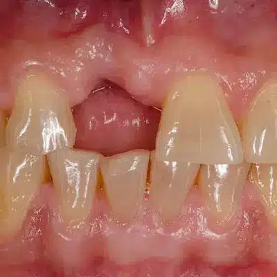 Tooth Replacement