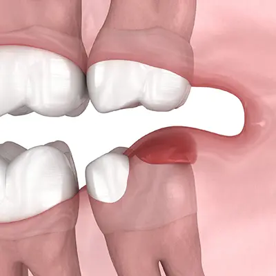 Wisdom Tooth Extraction