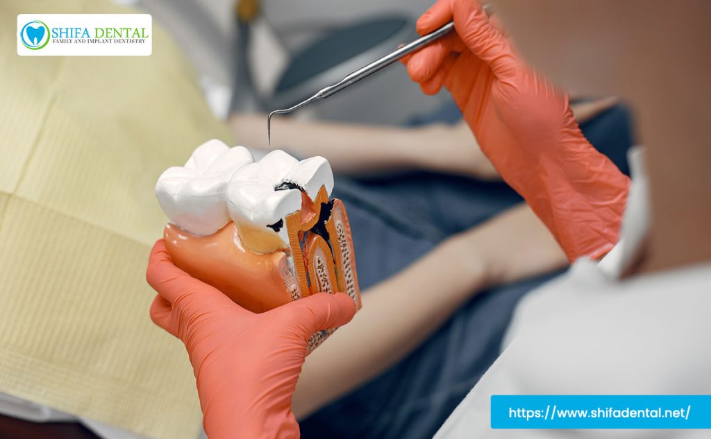 root canal