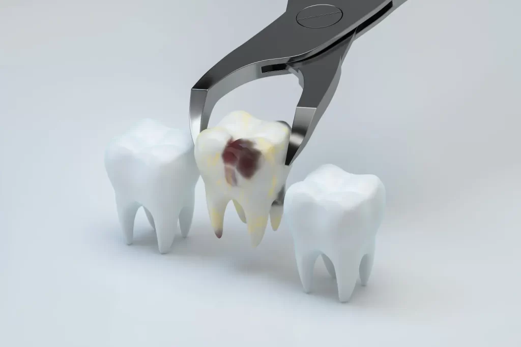 Affordable Dental Extractions