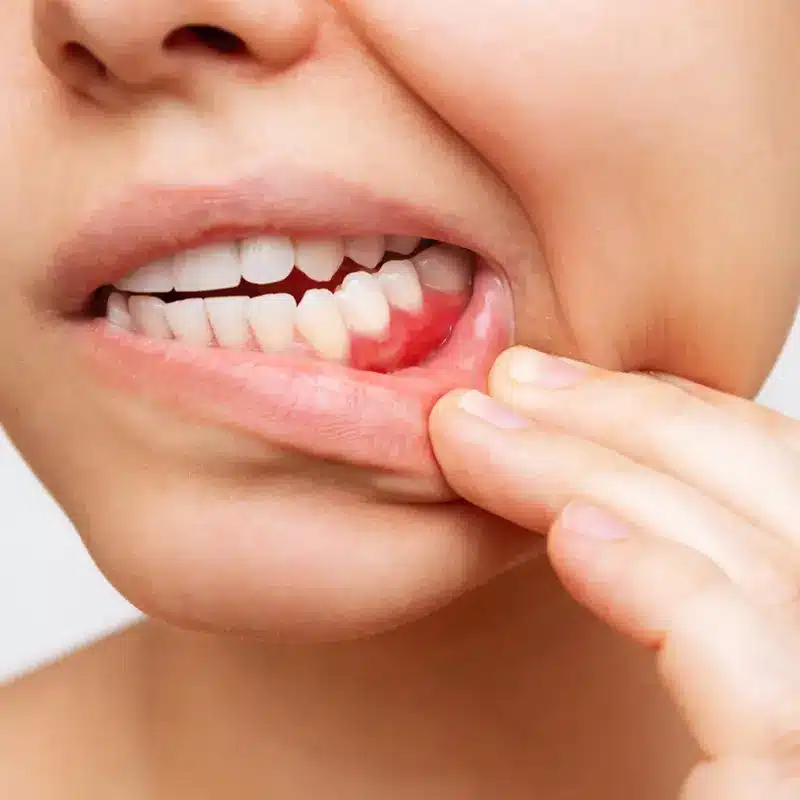 Are You a Candidate for Periodontal Therapy in Plano