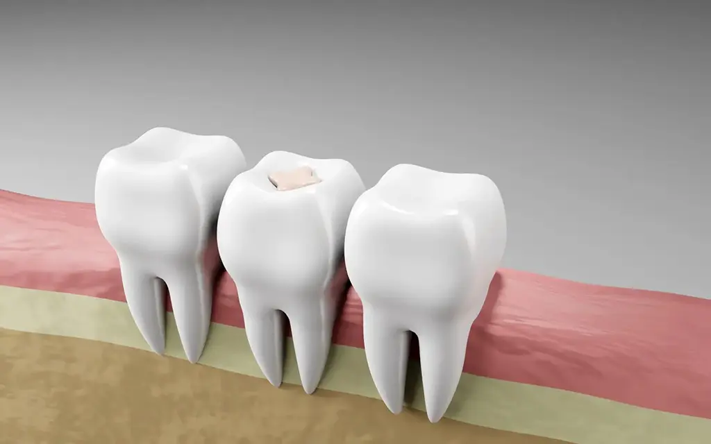 Affordable Dental Fillings Garland TX