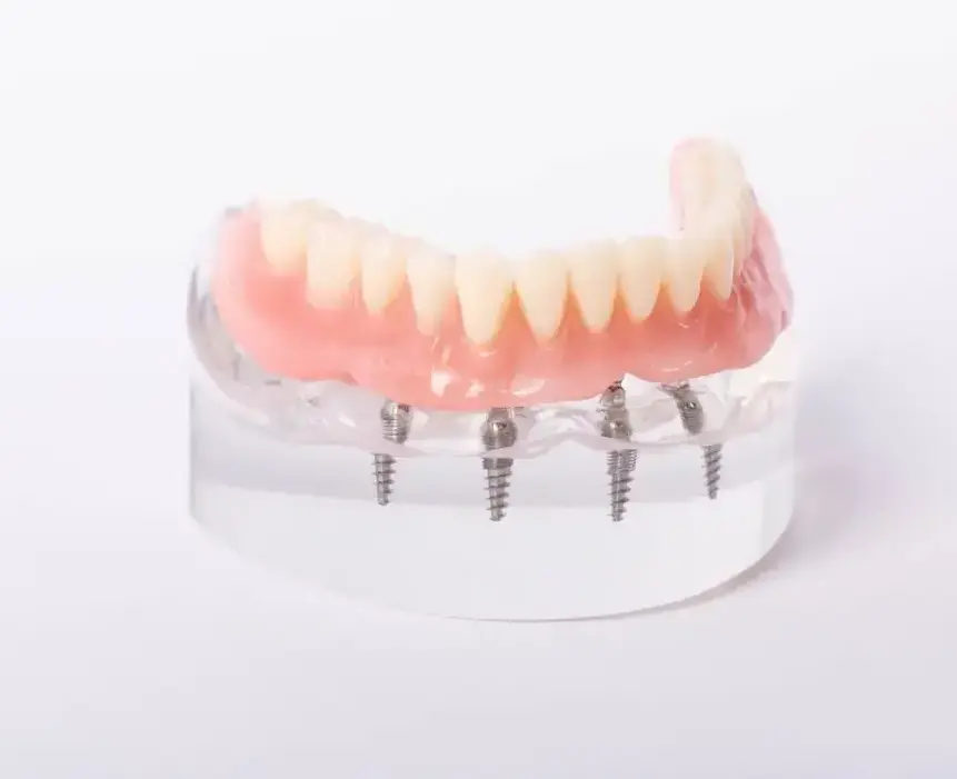 Cost of Implant Over Denture In Garland