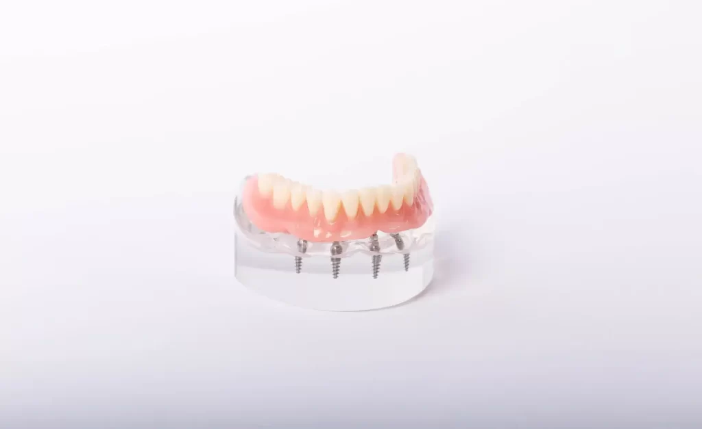 Cost of All-On-4 Dental Implants In Garland