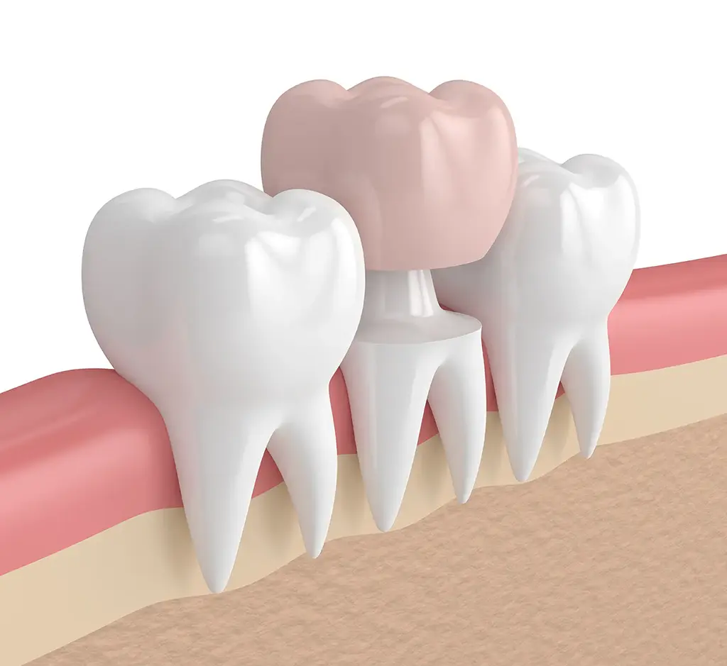 Cost of Dental Crowns In Garland