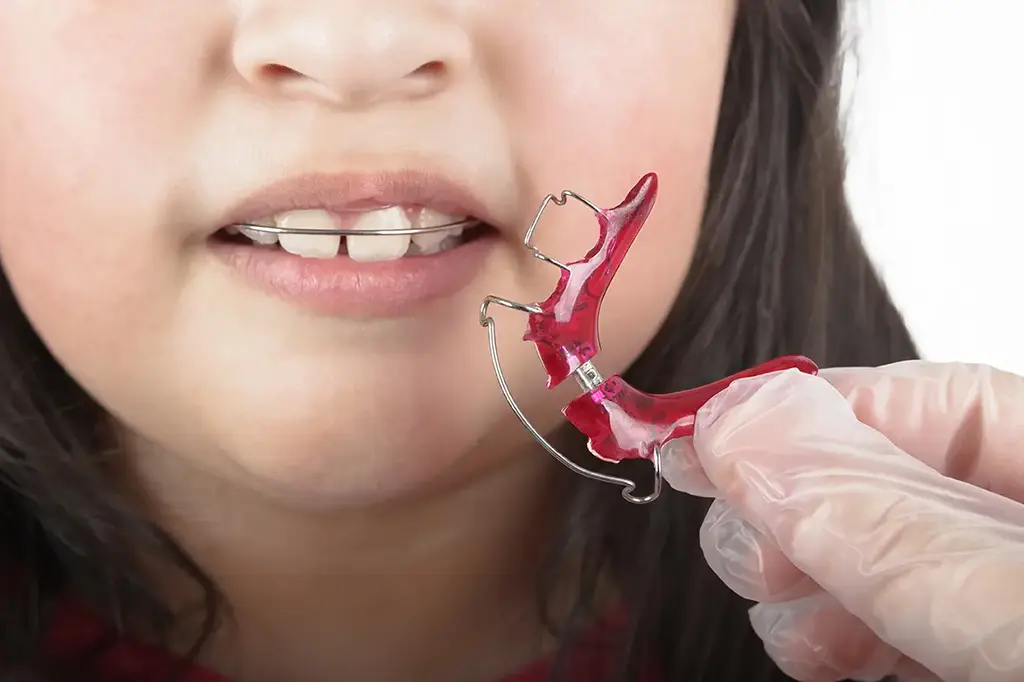 Cost of Dental Retainers In Garland