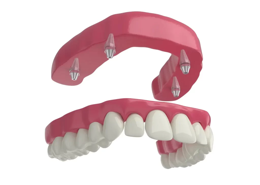 All-On-4 Dental Implants In Garland