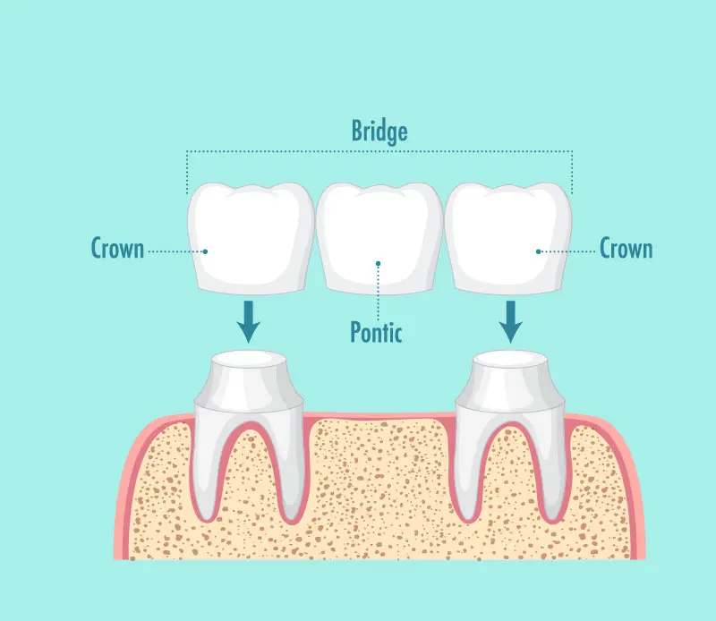 Dental Bridges In Garland