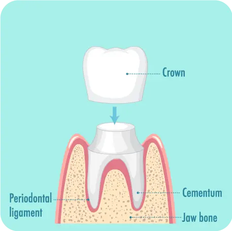 Dental Crowns In Garland