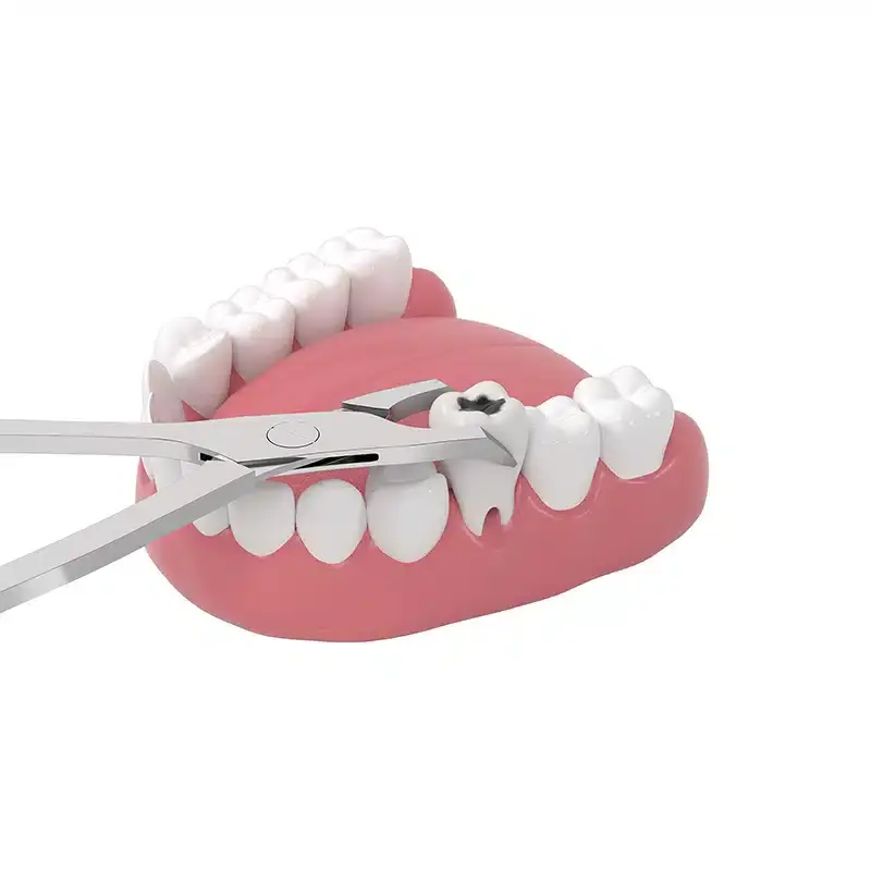 Dental Extractions