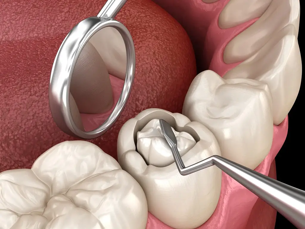 Dental Fillings In Garland