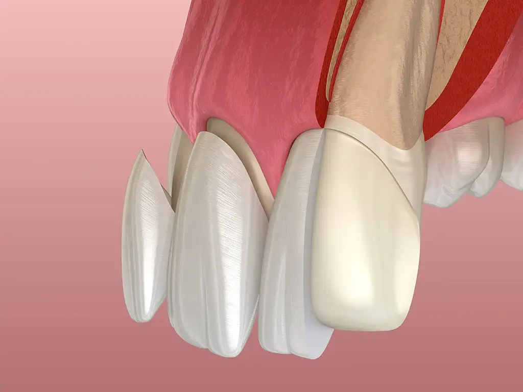 Veneers In Garland