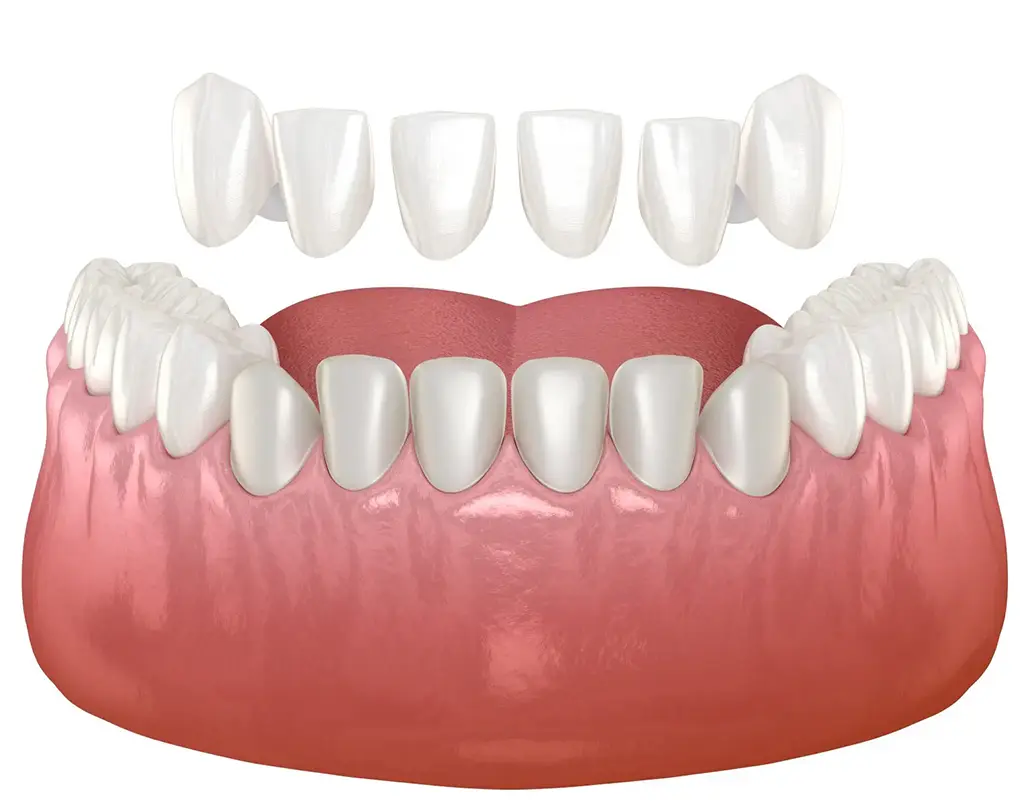 Veneers In Plano