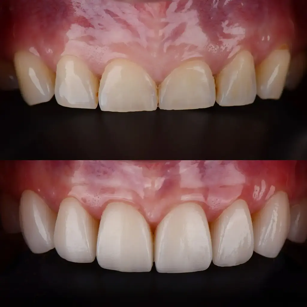 Crown Lengthening In Garland
