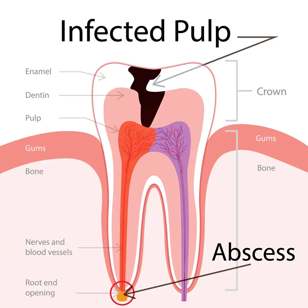 Endodontic Treatment In Garland