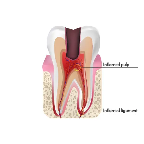 Endodontic Treatment