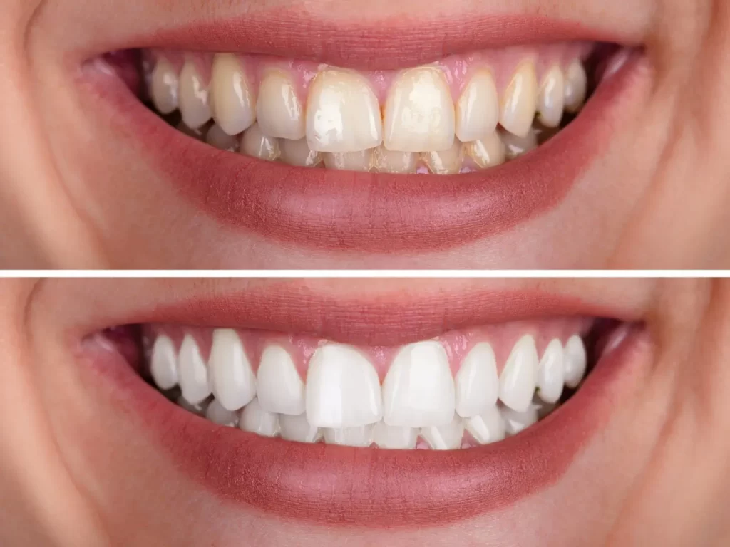 Best In Office Teeth Whitening