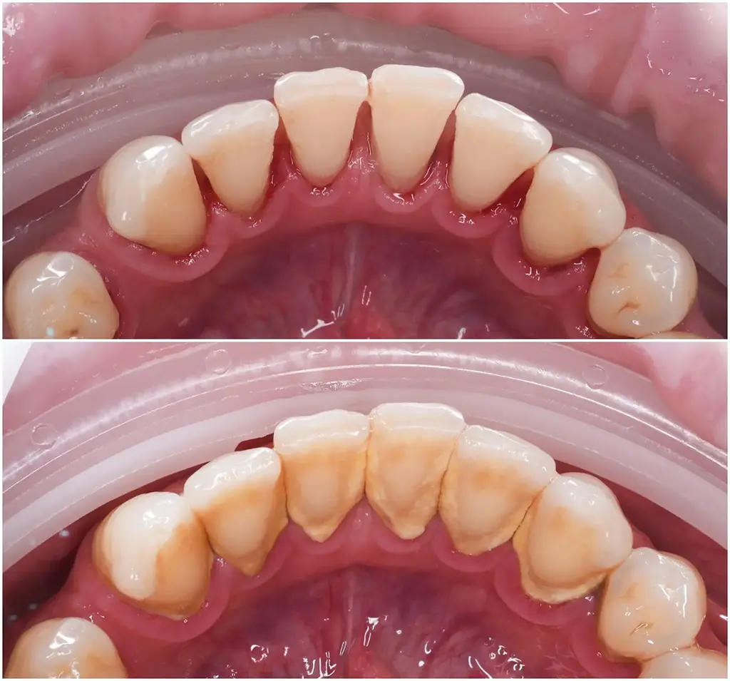 Teeth Cleaning In Garland