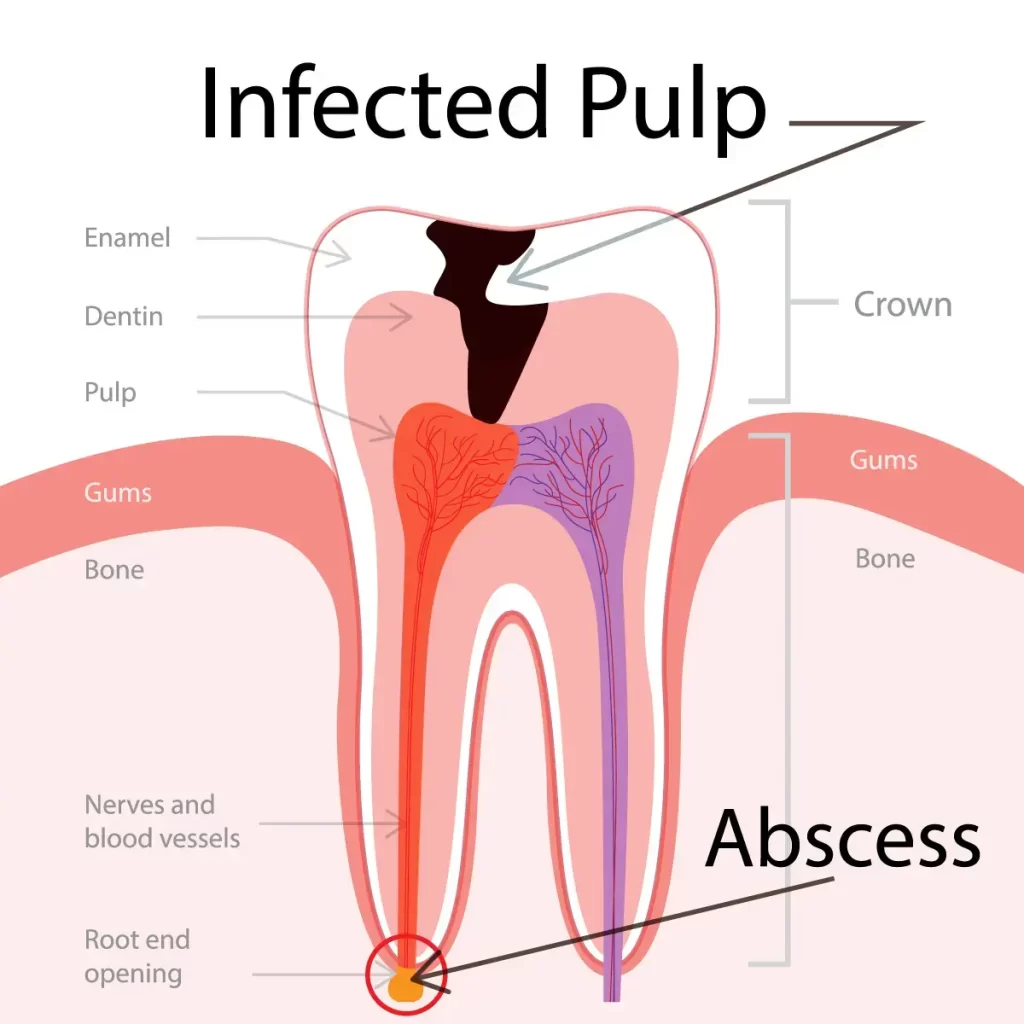 Root Canal Therapy