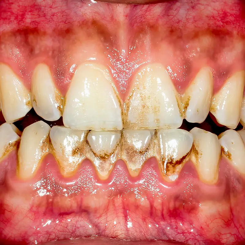 Professional Teeth Cleaning Plano TX