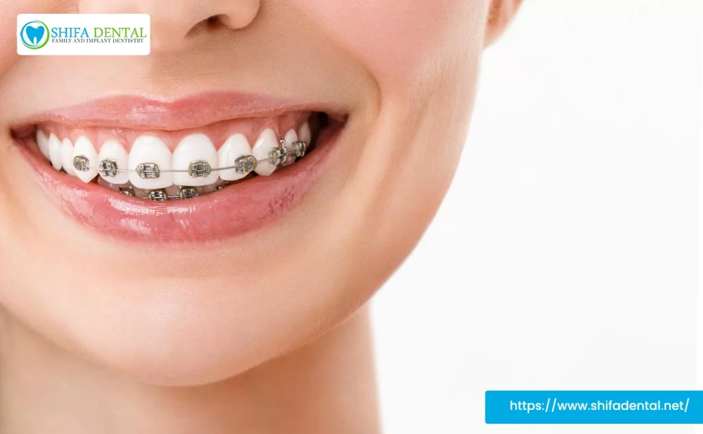 underbite treatment