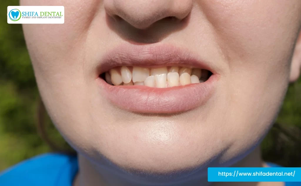 underbite treatment plano
