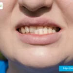 underbite treatment plano